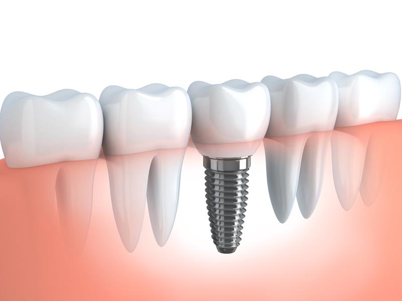 Dental Implants  Burley, ID 